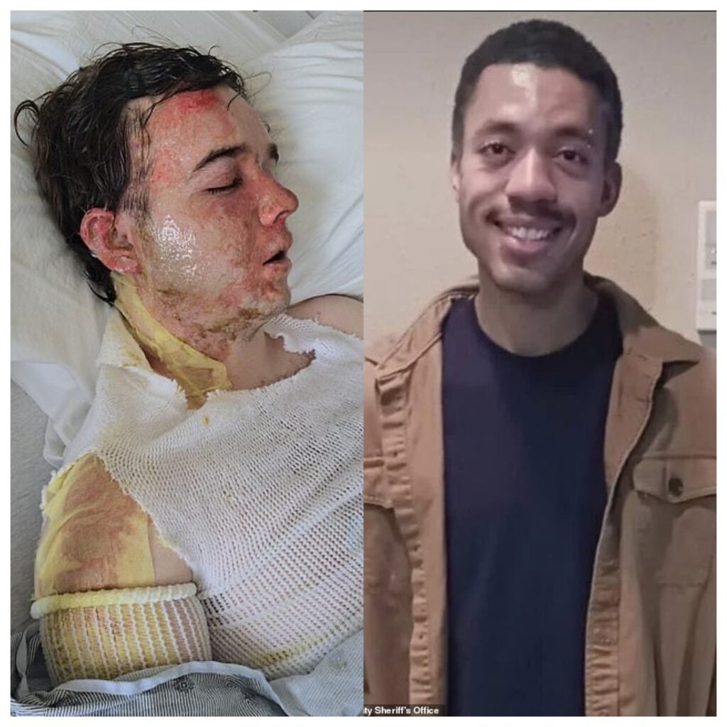 McDonald’s Worker Scalded By Hot Oil Speaks Out From Hospital Bed